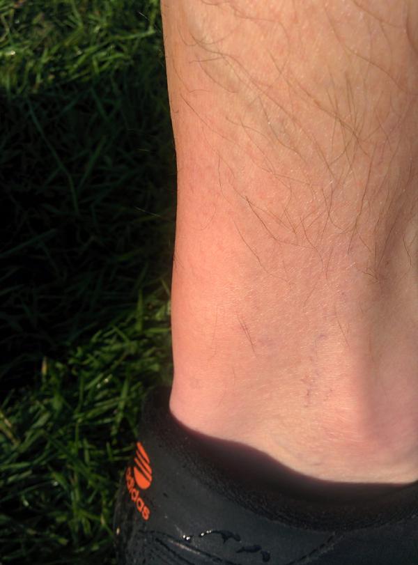 A close-up photograph of a person&rsquo;s lower leg and ankle showing what appears to be an injury or medical condition affecting the Achilles tendon area. The skin appears reddened or inflamed, and the person is wearing dark colored cycling shoes with visible branding.